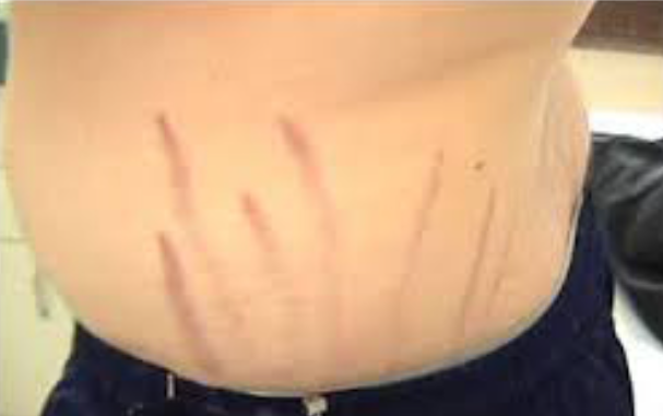 Bartonella tracks on side